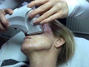 STK-MULTILINE Behandlung im Gesicht